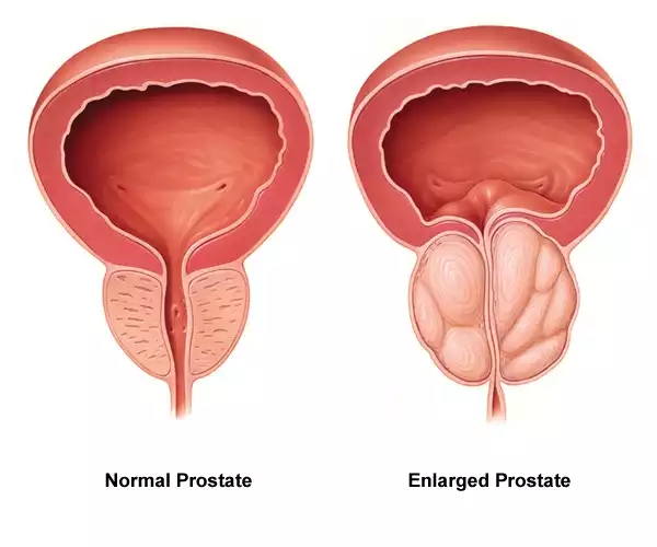 ProstaClear